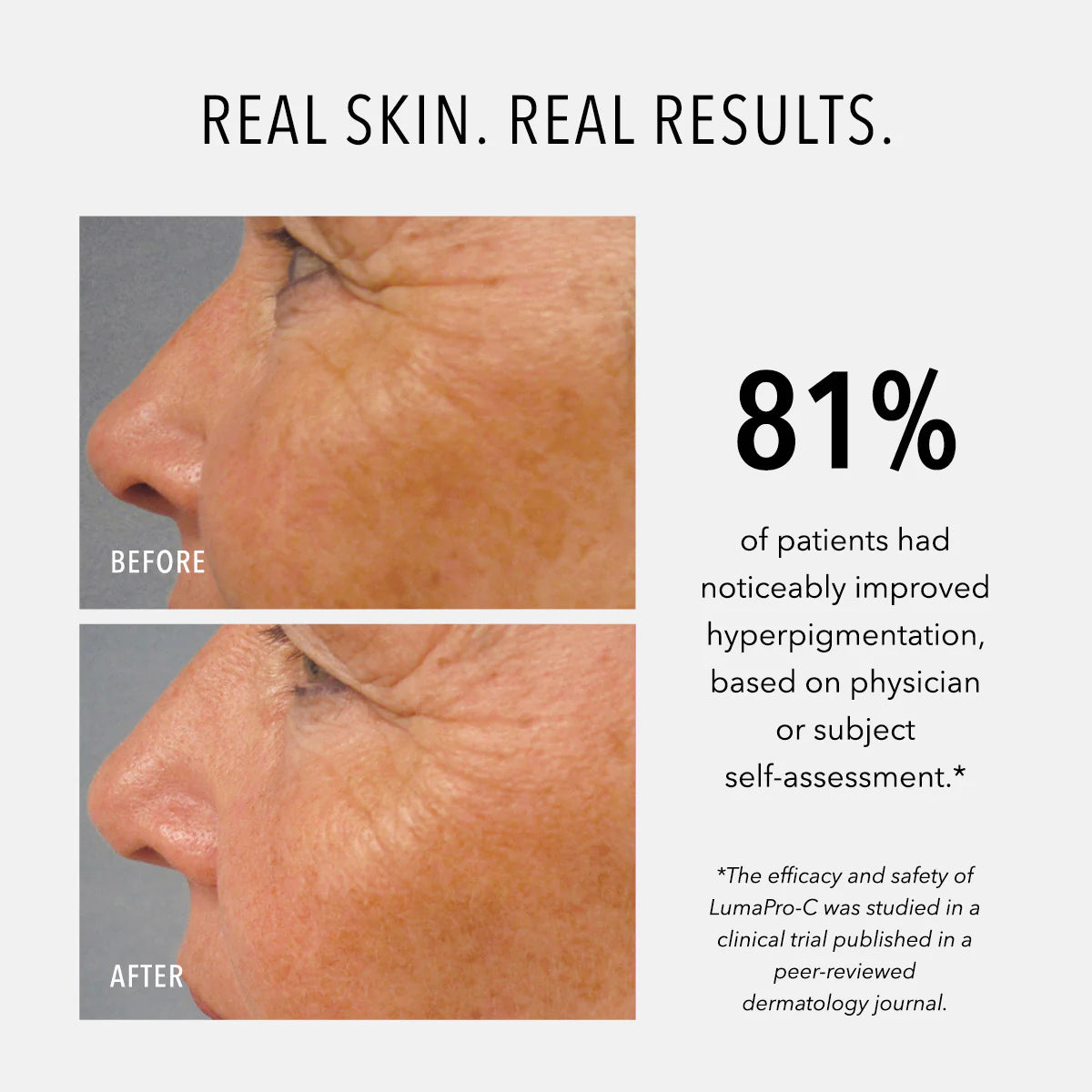 LumaPro-C Serum, Skin Brightening Pigment Corrector