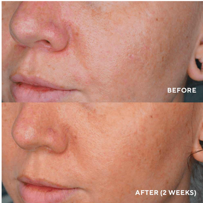 LumaPro-C Serum, Skin Brightening Pigment Corrector
